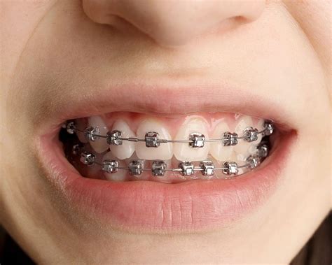 brackets metalico|brackets metalicos.